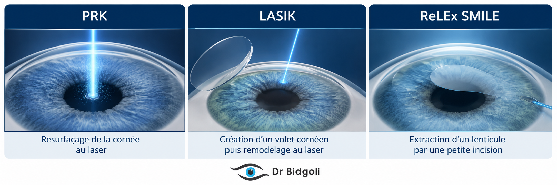 techniques de chirurgie laser des yeux à Bruxelles
