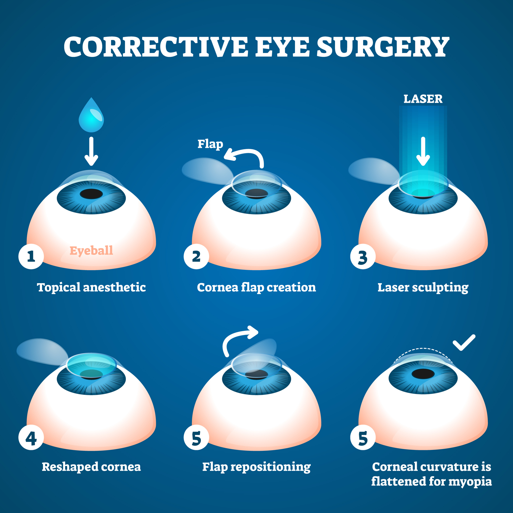 chirurgie laser des yeux technique du capot uccle