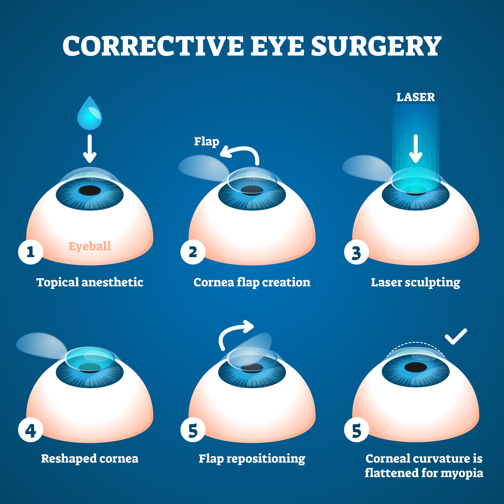 Chirurgie Laser Des Yeux Technique Du LASIK Uccle