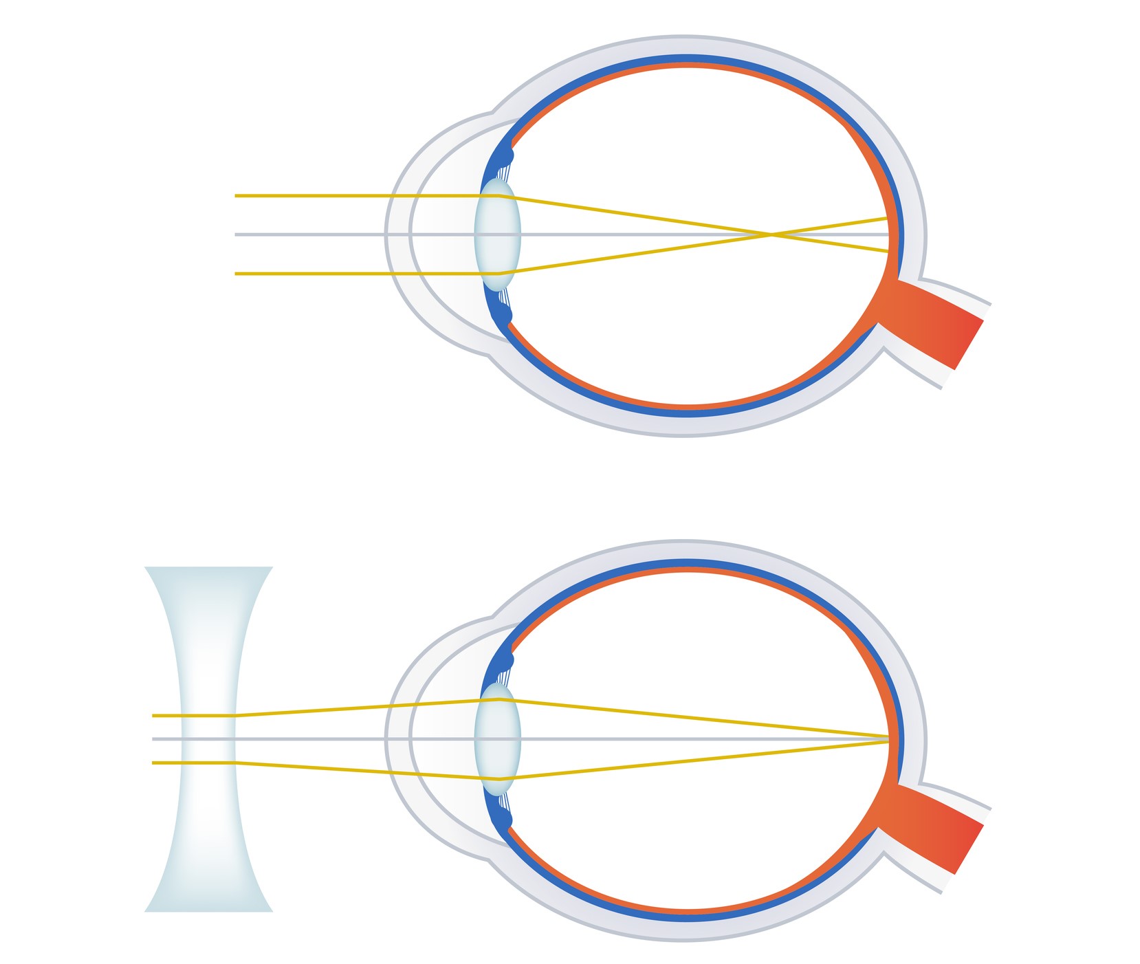 ophtalmologue myopie uccle